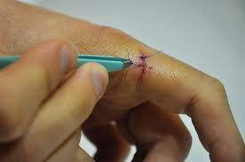 Stitch Removal ₹100